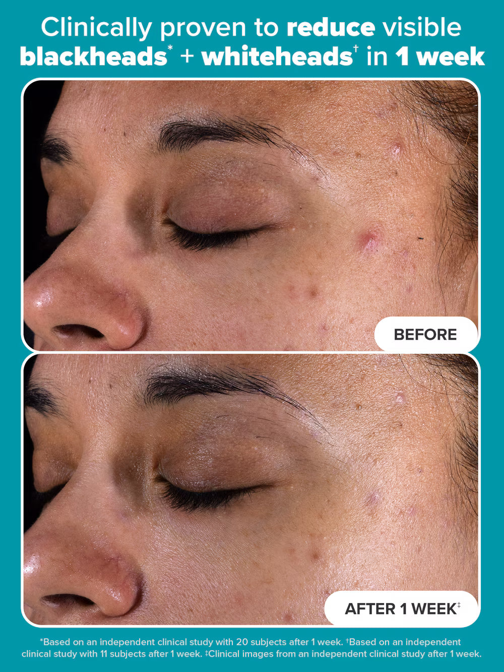 Paulas Choice--SKIN PERFECTING 2% BHA Liquid Salicylic Acid Exfoliant--Facial Ex