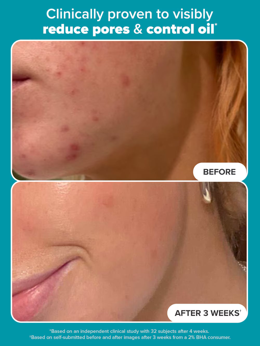 Paulas Choice--SKIN PERFECTING 2% BHA Liquid Salicylic Acid Exfoliant--Facial Ex