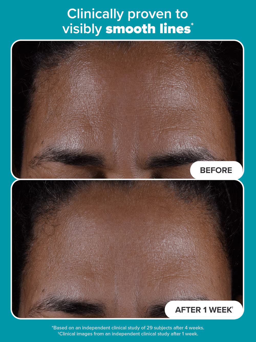 Paulas Choice--SKIN PERFECTING 2% BHA Liquid Salicylic Acid Exfoliant--Facial Ex